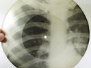 X-Ray 78rpm SOKOLSKY I had a dream Tango RARE USSR ROENTGEN Ribs Thorax 1950s
