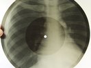 X-Ray 78rpm LESHCHENKO Farewell My Gypsy Camp RARE USSR ROENTGEN Ribs Bones 1950