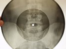 X-Ray 78rpm SHULZHENKO Sings Waltz Jazz USSR AUDIO ROENTGEN Spine Pelvis Bones
