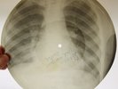 X-Ray 78rpm VERTINSKY & Orchestra Madame USSR AUDIO ROENTGEN Ribs Thorax Bones