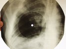 X-Ray 78rpm LESHCHENKO Mischa Foxtrot USSR AUDIO ROENTGEN Ribs Shoulder Bones