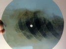DEVUSHKA V PLAT'E IZ SITTSA - UNKNOWN ARTIST- USSR GEORGIAN X-RAY ROENTGEN BONES