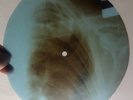 LOUIS ARMSTRONG - LA VIE EN ROSE - UNIQUE USSR GEORGIAN X-RAY ROENTGEN RIBS