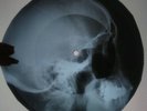 Bob Dylan - Subterranean Homesick Blues X-RAY USSR ROENTGEN Bones Record
