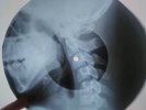 David Bowie - Ziggy Stardust X-RAY USSR ROENTGEN Bones Record SKULL