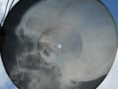 ASIAN (IRAN?) FOLK MUGHAM - USSR GEORGIAN X-RAY ROENTGEN SKULL RECORD - LISTEN