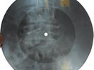 DAVID BOWIE - HAVE YOU EVER HAD A DREAM - USSR X-RAY ROENTGEN RIBS SPINE RECORD