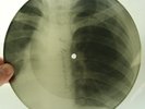 X-RAY 78rpm WERTINSKY In Moldavian steppe USSR ROENTGEN BONES Ribs Thorax 1950s