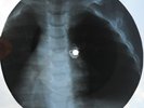 BEACH BOYS - SHUT DOWN -USSR GEORGIAN X-RAY ROENTGEN SPINE AND RIBS BONES RECORD