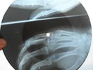 JOHNNY CASH - SO DOGGONE LONESOME - USSR GEORGIAN X-RAY ROENTGEN BONES RECORD