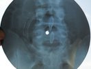 PINK FLOYD - CIRRUS MINOR - USSR GEORGIAN X-RAY ROENTGEN BONES RECORD