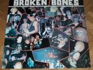 Broken Bones-