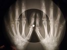 Beatles - Yellow Submarine X-RAY OF THE USSR X-RAY BONES RECORD