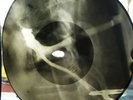 USSR GEORGIAN X-RAY ROENTGEN BONES  RECORD  UNIQUE ITEM 100% ORIGINAL
