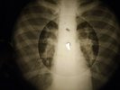 David Bowie - Rebel Rebel X-RAY OF USSR X-RAY BONES RECORDING