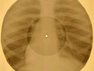 Simon  and Garfunkel - Mrs. Robinson  X-RAY OF USSR X-RAY BONE RECORD