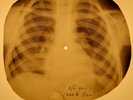 Johnny Cash - Ballad Of A Teen  X-RAY OF USSR X-RAY BONES RECORDING