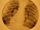 David Bowie - Kooks X-RAY OF USSR X-RAY BONES RECORDING