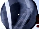 USSR GEORGIAN X-RAY ROENTGEN BONES  RECORD  UNIQUE ITEM 100% ORIGINAL