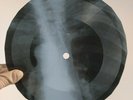 DAVID BOWIE SPACE ODDITY X-Ray USSR Record Roentgen Bones Ribs Music Vinyl