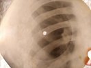 USSR GEORGIAN X-RAY ROENTGEN BONES  RECORD  UNIQUE ITEM  ORIGINAL georgian folk