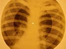 Doors - Unhappy Girl  X-RAY OF THE USSR X-RAY BONE RECORDING