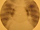 David Bowie - After All X-RAY OF USSR X-RAY BONES RECORD