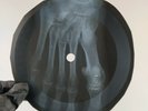 NINA SIMONE HE NEEDS ME X-Ray USSR Record Roentgen Ribs Bones Music Vinyl