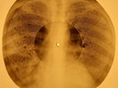 David Bowie - Space Oddity  X-RAY OF USSR X-RAY BONES RECORD