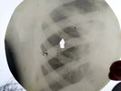 USSR GEORGIAN X-RAY ROENTGEN BONES  RECORD  UNIQUE ITEM 100% ORIGINAL folk