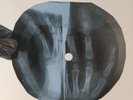 BILLY FURY COLETTE X-Ray USSR Record Roentgen Bones Ribs Music Vinyl