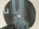 DOORS UNHAPPY GIRL X-Ray USSR Record Roentgen Bone Ribs Music Vinyl