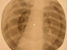 USSR X-RAY ROENTGEN BONES RECORD ORIGINAL OLD RIBS 442