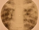 USSR X-RAY ROENTGEN BONES RECORD ORIGINAL OLD RIBS 447
