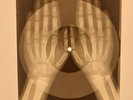 USSR X-RAY ROENTGEN BONES RECORD ORIGINAL OLD RIBS 457