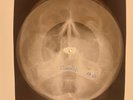 USSR X-RAY SKULL ROENTGEN BONES RECORD ORIGINAL OLD RIBS 456