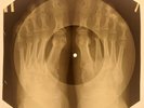 USSR X-RAY ROENTGEN BONES RECORD ORIGINAL OLD RIBS 441