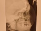 USSR X-RAY SKULL ROENTGEN BONES RECORD ORIGINAL OLD RIBS 452