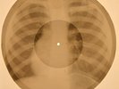 USSR X-RAY ROENTGEN BONES RECORD ORIGINAL OLD RIBS 462