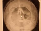 X-RAY SKULL USSR ROENTGEN BONES RECORD ORIGINAL OLD RIBS 479
