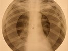 X-RAY USSR  ROENTGEN BONES RECORD ORIGINAL OLD RIBS 471