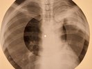 USSR X-RAY  ROENTGEN BONES RECORD ORIGINAL OLD RIBS 493