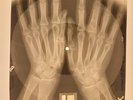X-RAY USSR  ROENTGEN BONES RECORD ORIGINAL OLD RIBS 501