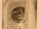 USSR X-RAY ROENTGEN BONES RECORD ORIGINAL OLD RIBS 504