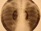 USSR X-RAY  ROENTGEN BONES RECORD ORIGINAL OLD RIBS 466