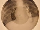 USSR X-RAY  ROENTGEN BONES RECORD ORIGINAL OLD RIBS 505