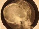 USSR X-RAY CHILD SKULL ROENTGEN BONES RECORD ORIGINAL OLD RIBS 494