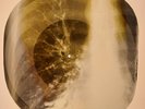 USSR X-RAY  ROENTGEN BONES RECORD ORIGINAL OLD RIBS 500