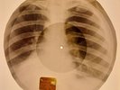 USSR X-RAY ROENTGEN BONES RECORD ORIGINAL OLD RIBS 513