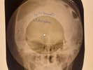 USSR X-RAY SKULL ROENTGEN BONES RECORD ORIGINAL OLD RIBS 499